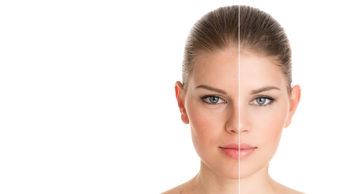 peeling-quimico peeling-quimico